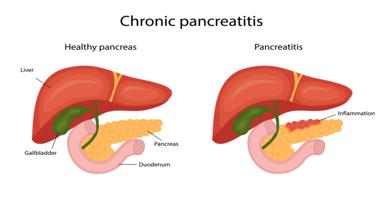 disease pancreatitis, infographic. liver and pancreas. vector illustration in cartoon style.