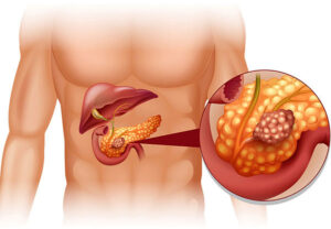 Pancreas Infection